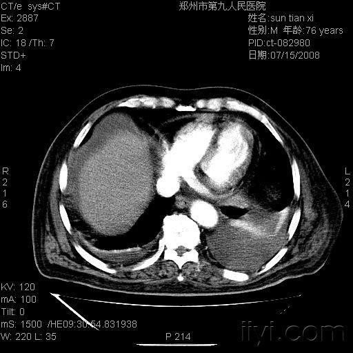 肝门静脉ct图片