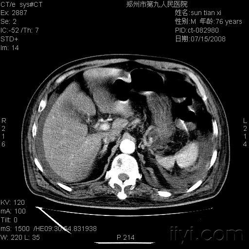请教ct对肝门静脉血栓敏感吗