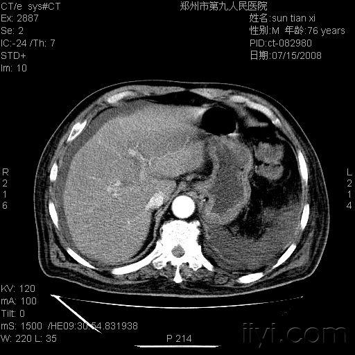 请教ct对肝门静脉血栓敏感吗