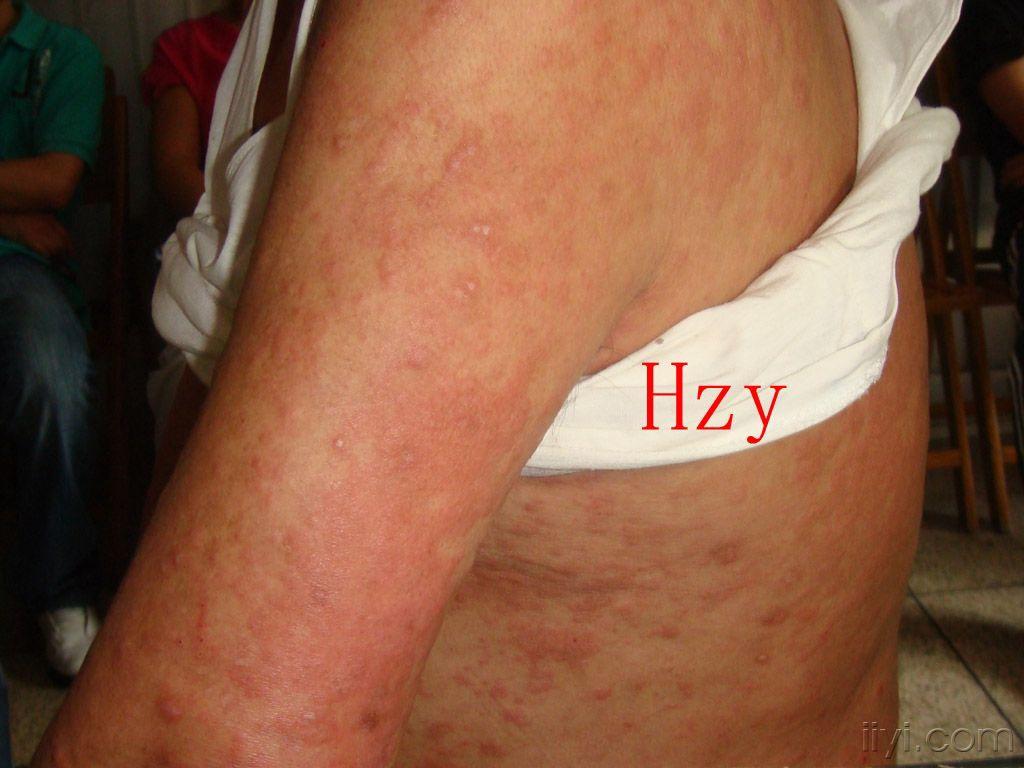 患者男性65岁全身瘙痒皮疹呈渐进性发展4年