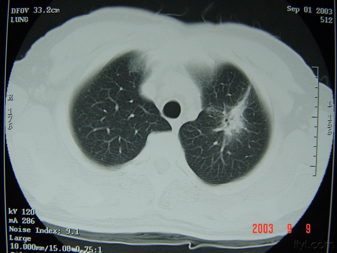 肺癌- 医学影像学讨论版 - 爱爱医医学论坛