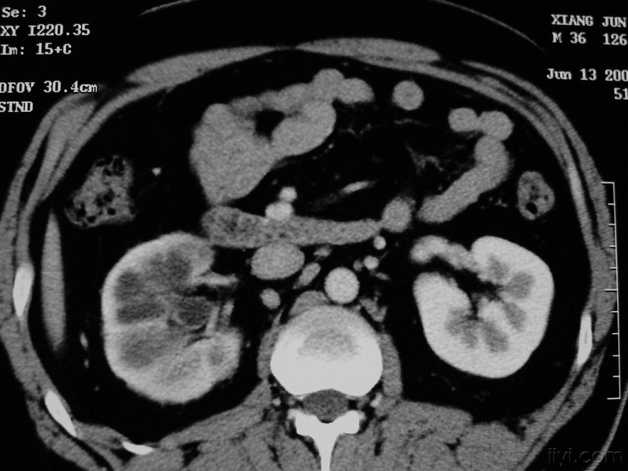 肾结核影像图片