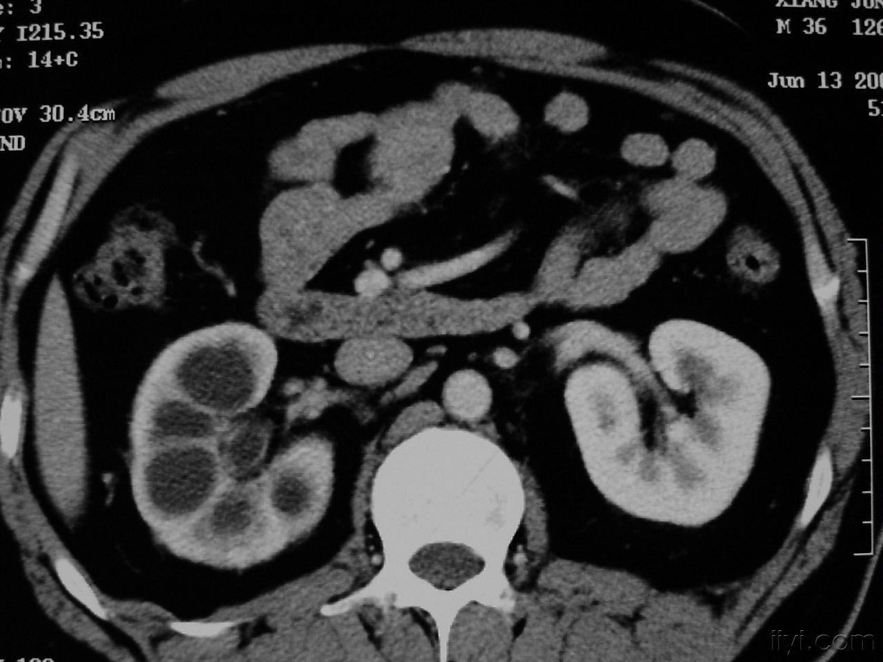 肾结核影像图片