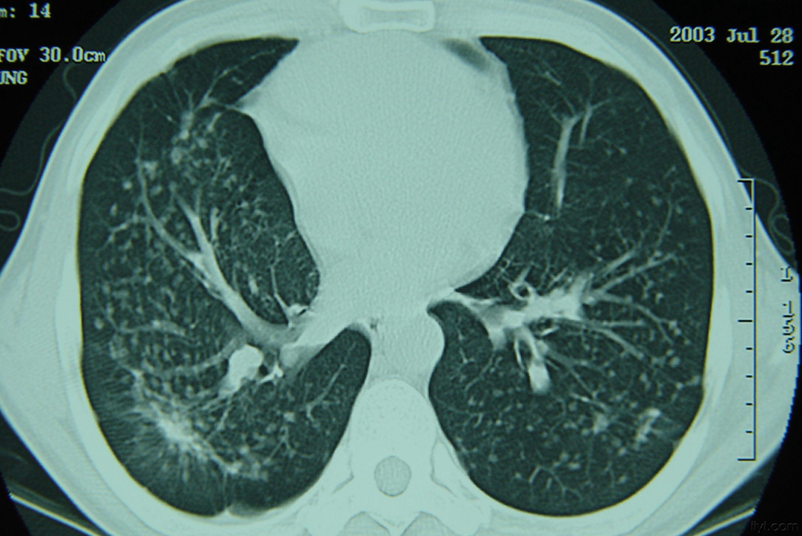 一期矽肺ct图片特征图片