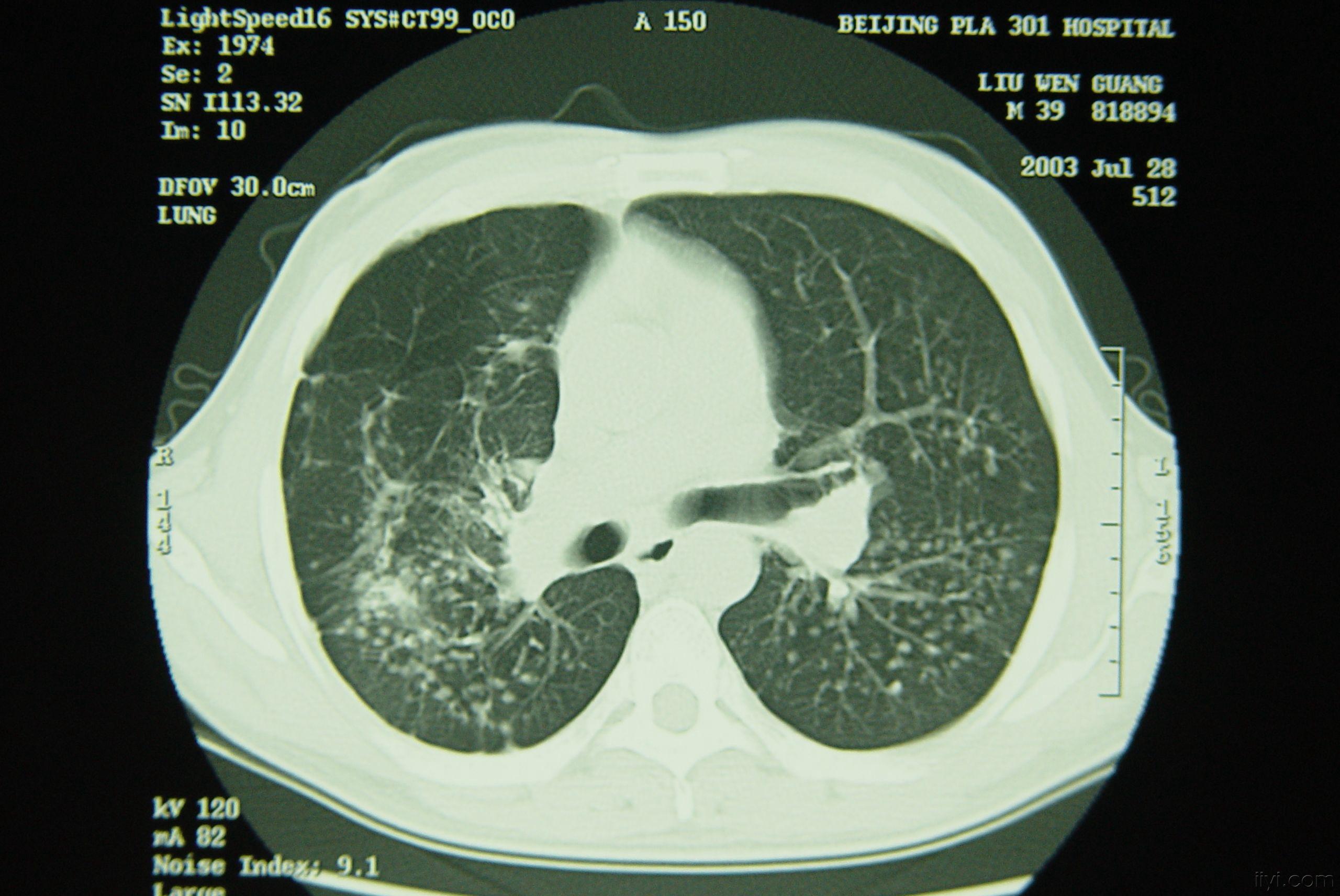一期矽肺ct图片特征图片