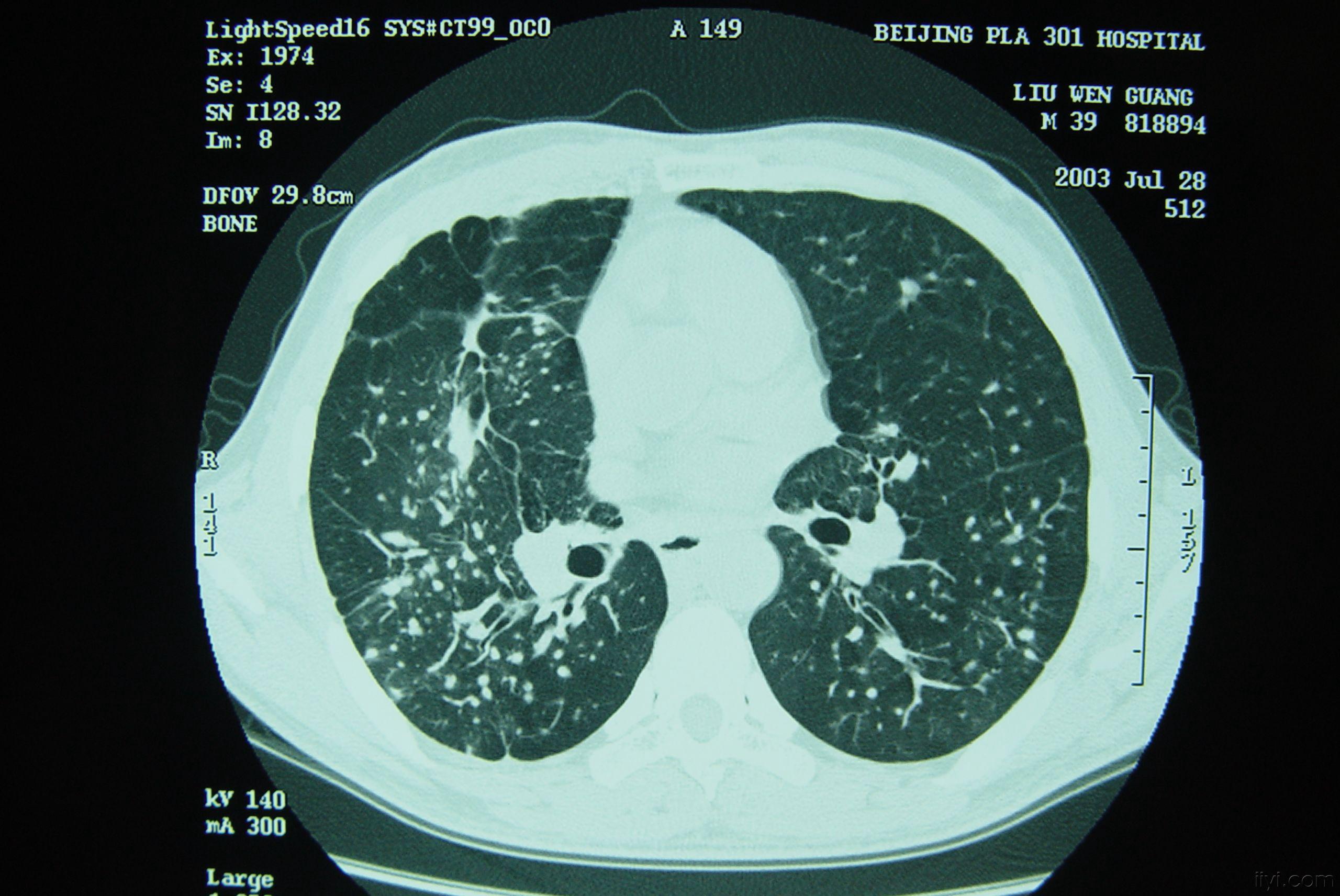 硅肺x线图片图片