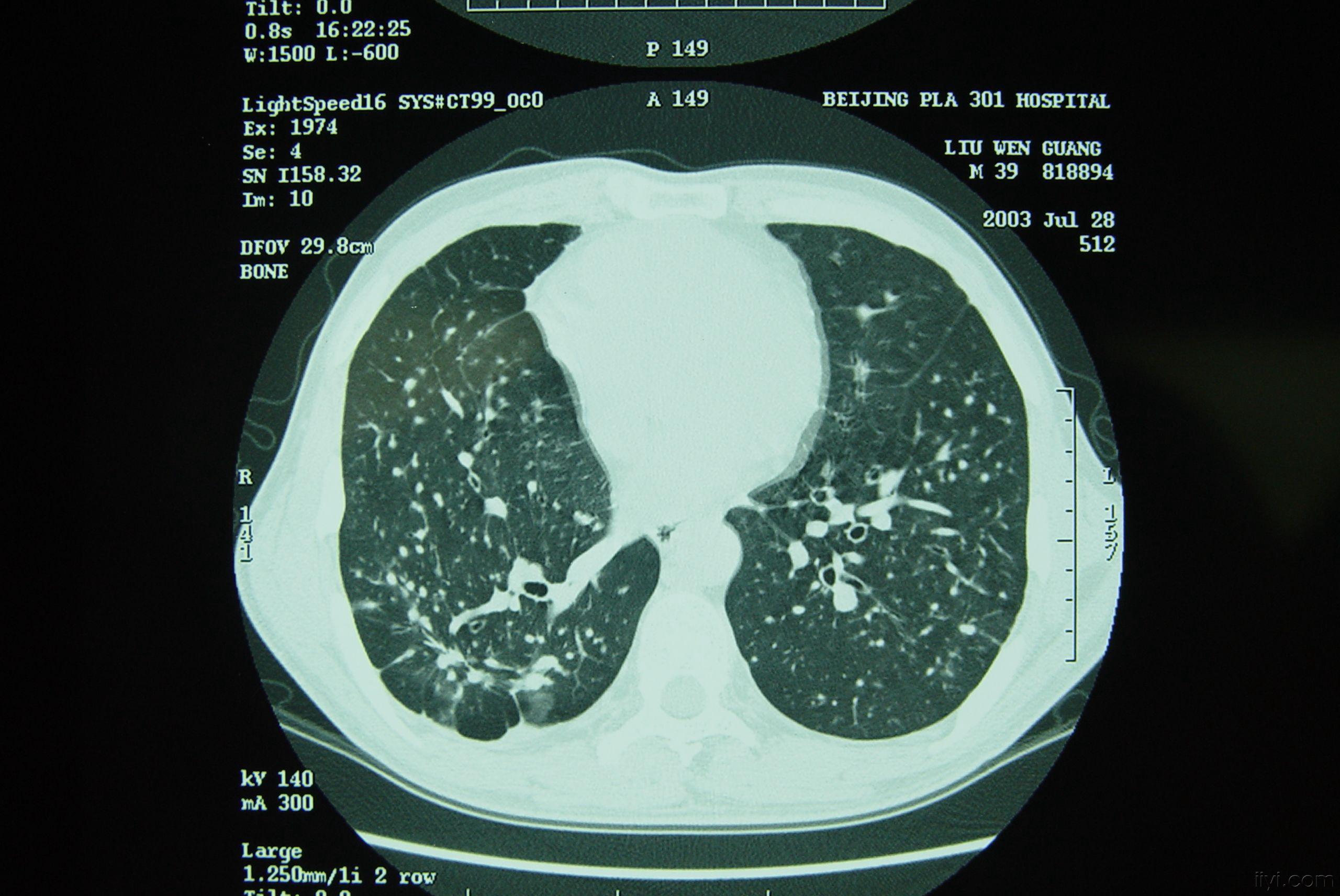 矽肺病ct图图片
