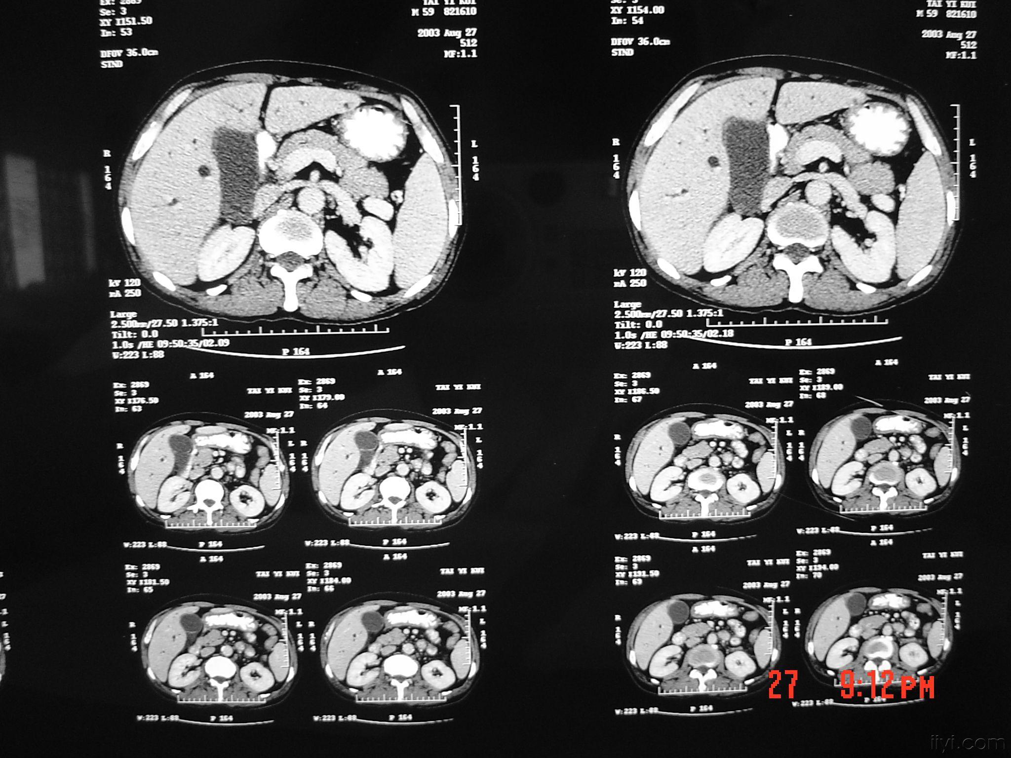 早期胆囊癌彩超图片