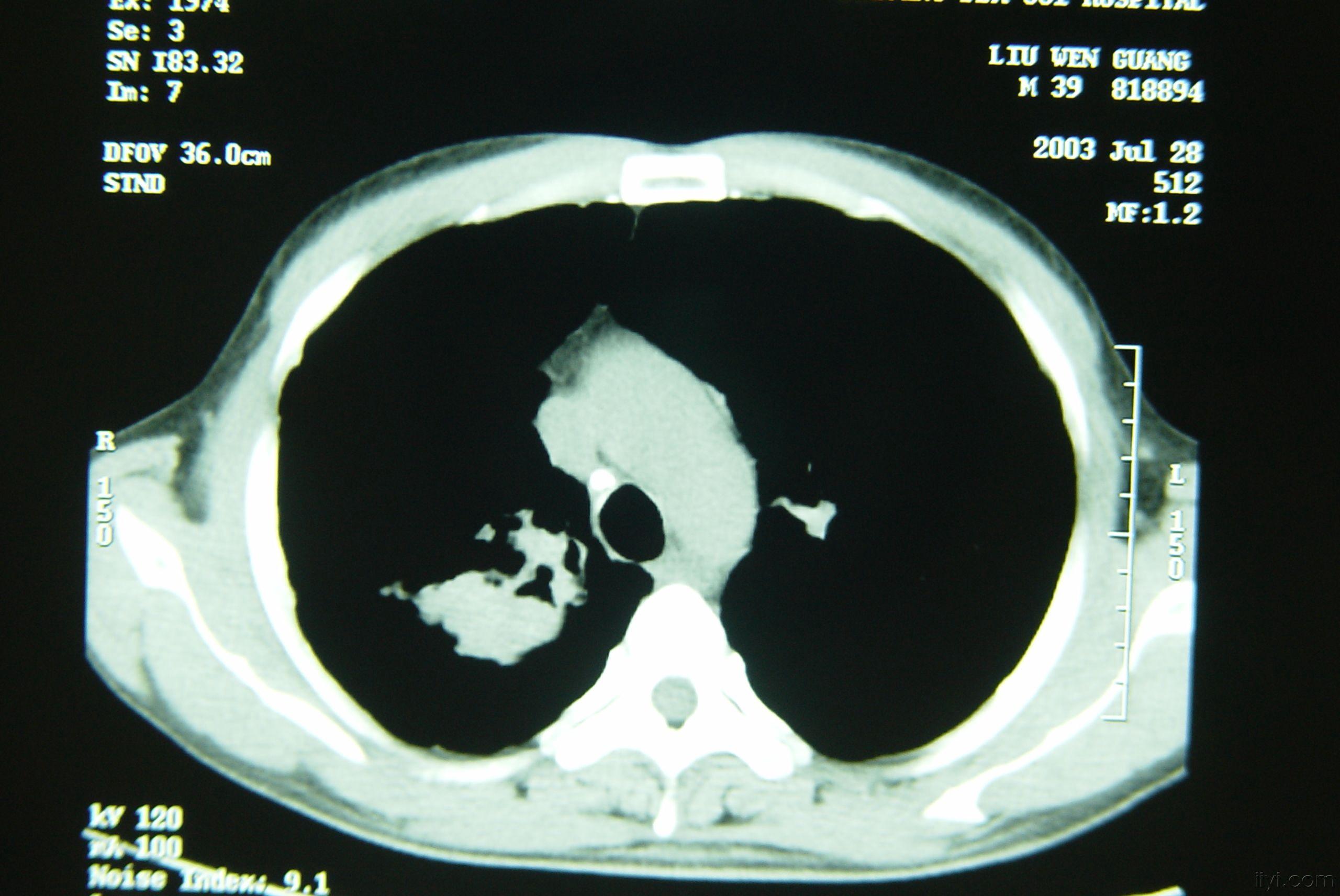 一期矽肺ct图片图片