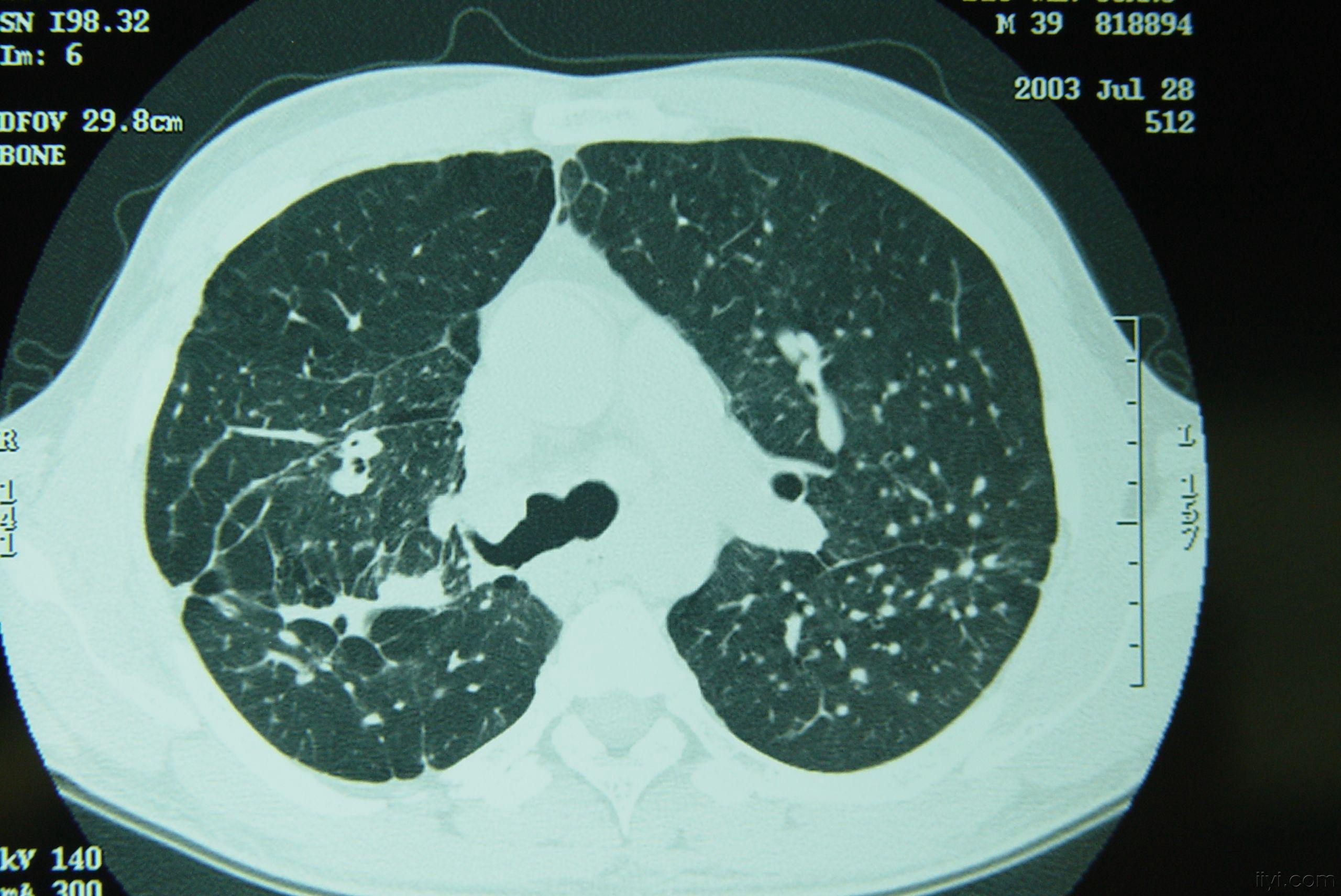 矽肺图片三期图片