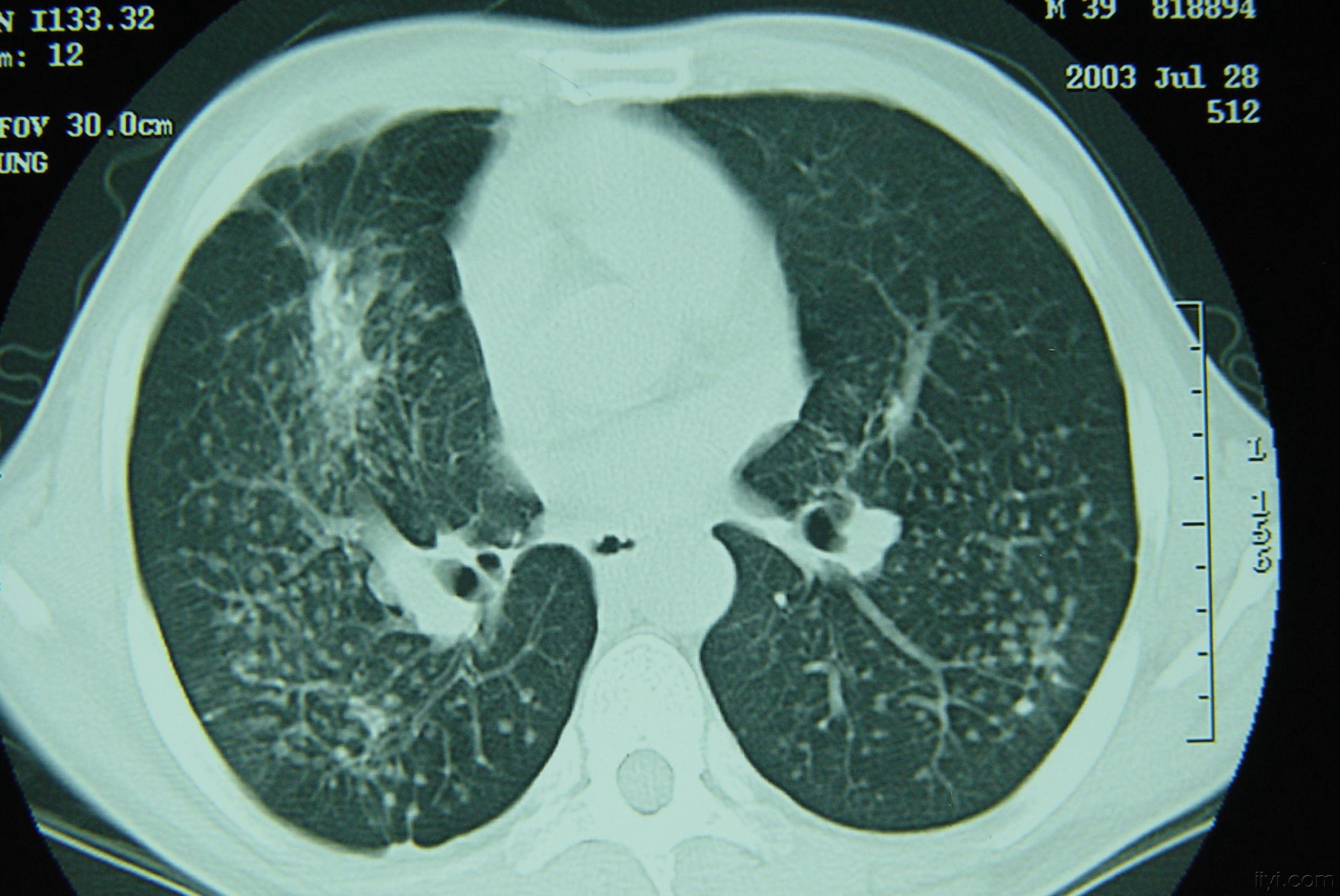 矽肺的肺部图片图片