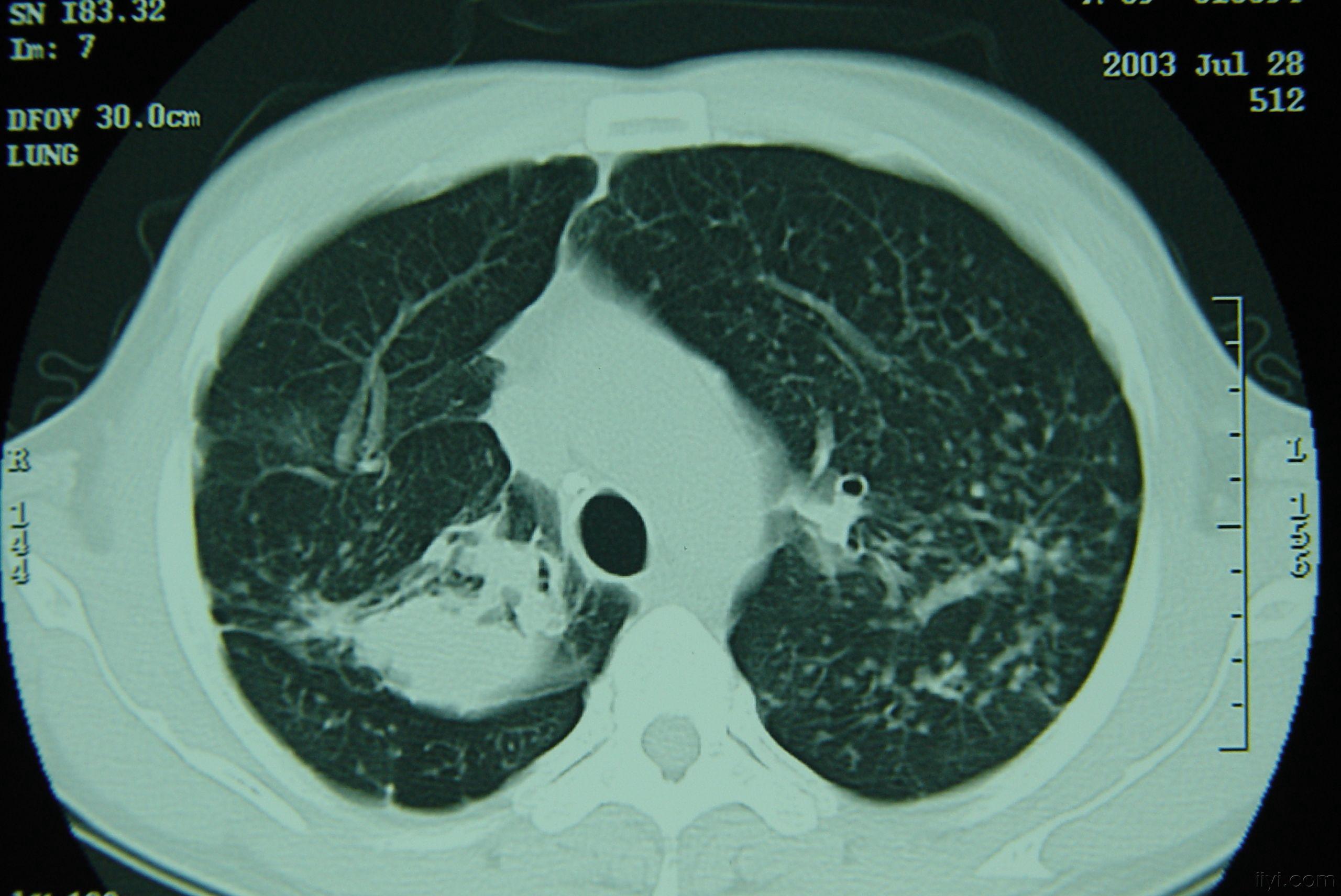 矽肺肺部ct图片图片