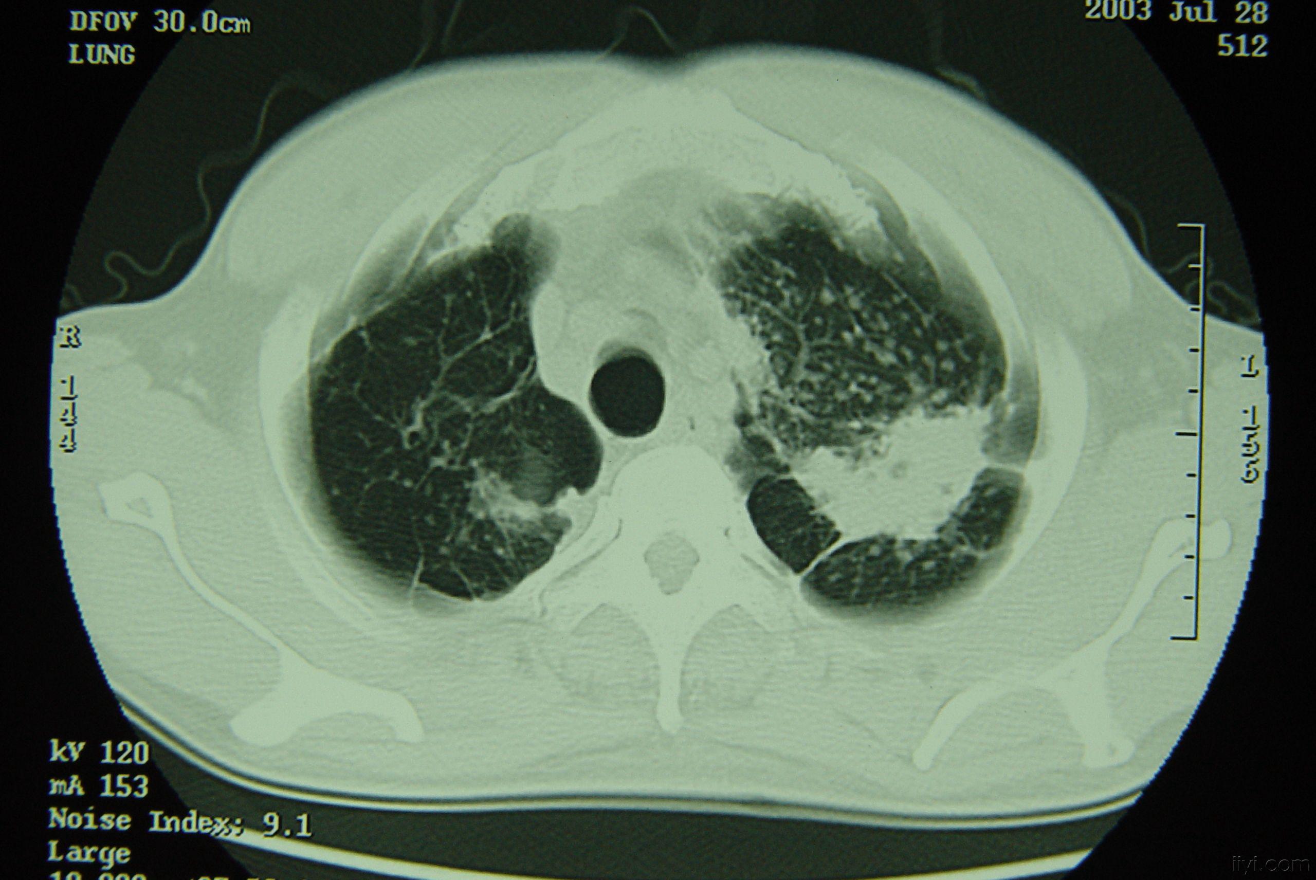 矽肺肺部ct图片图片