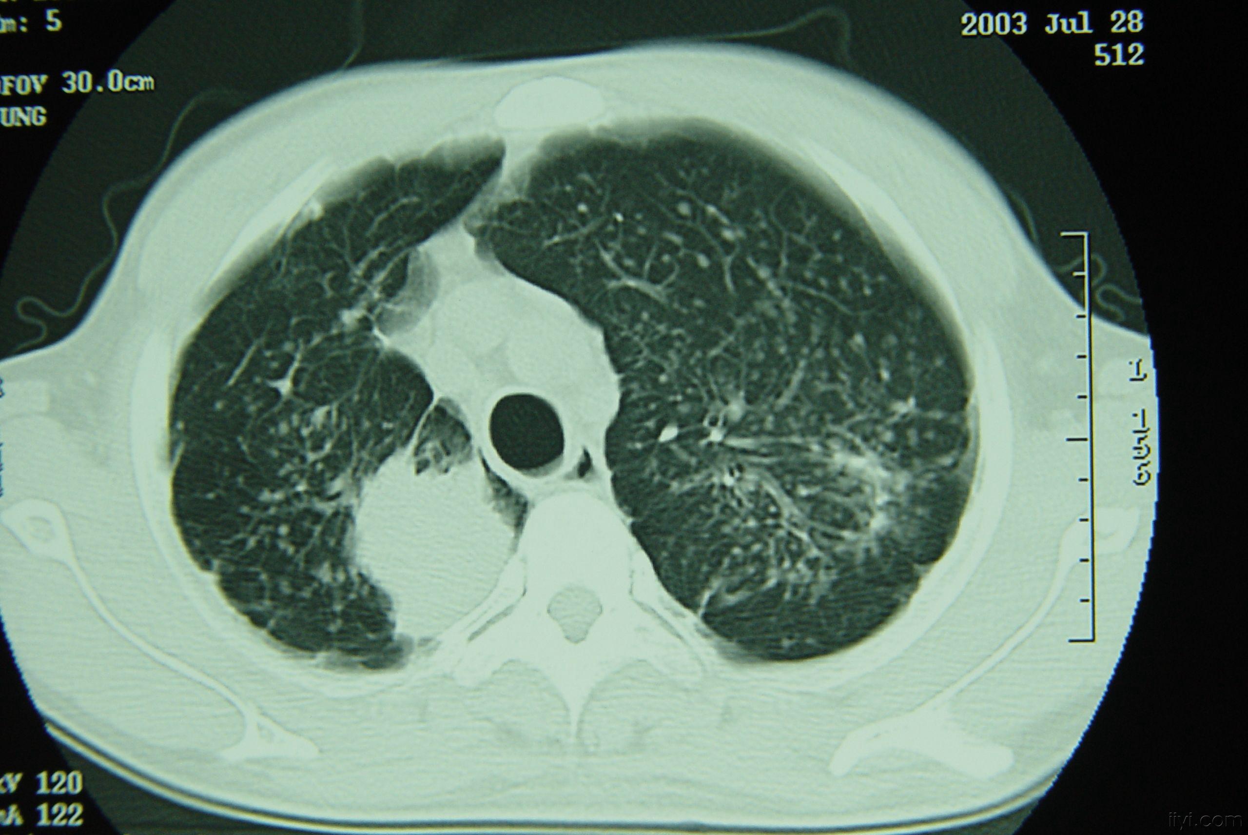 矽肺三期图片