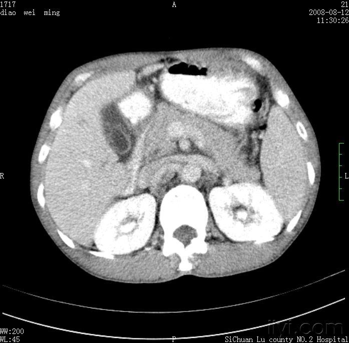 胆囊内息肉结石