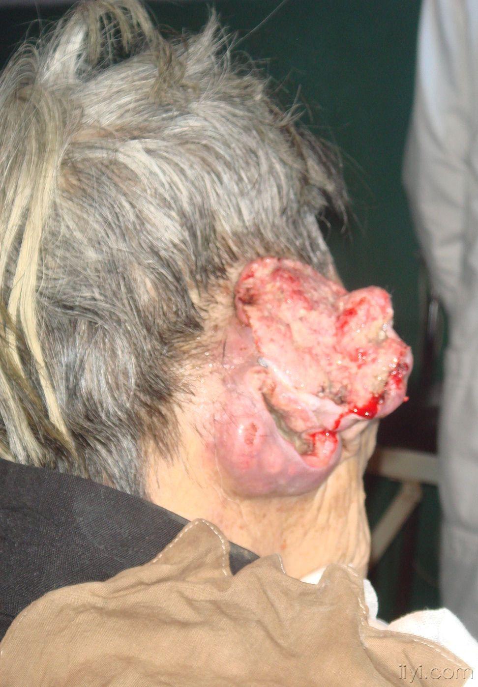 耳朵软骨瘤图片图片
