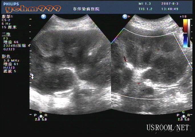 肾结核超声图片