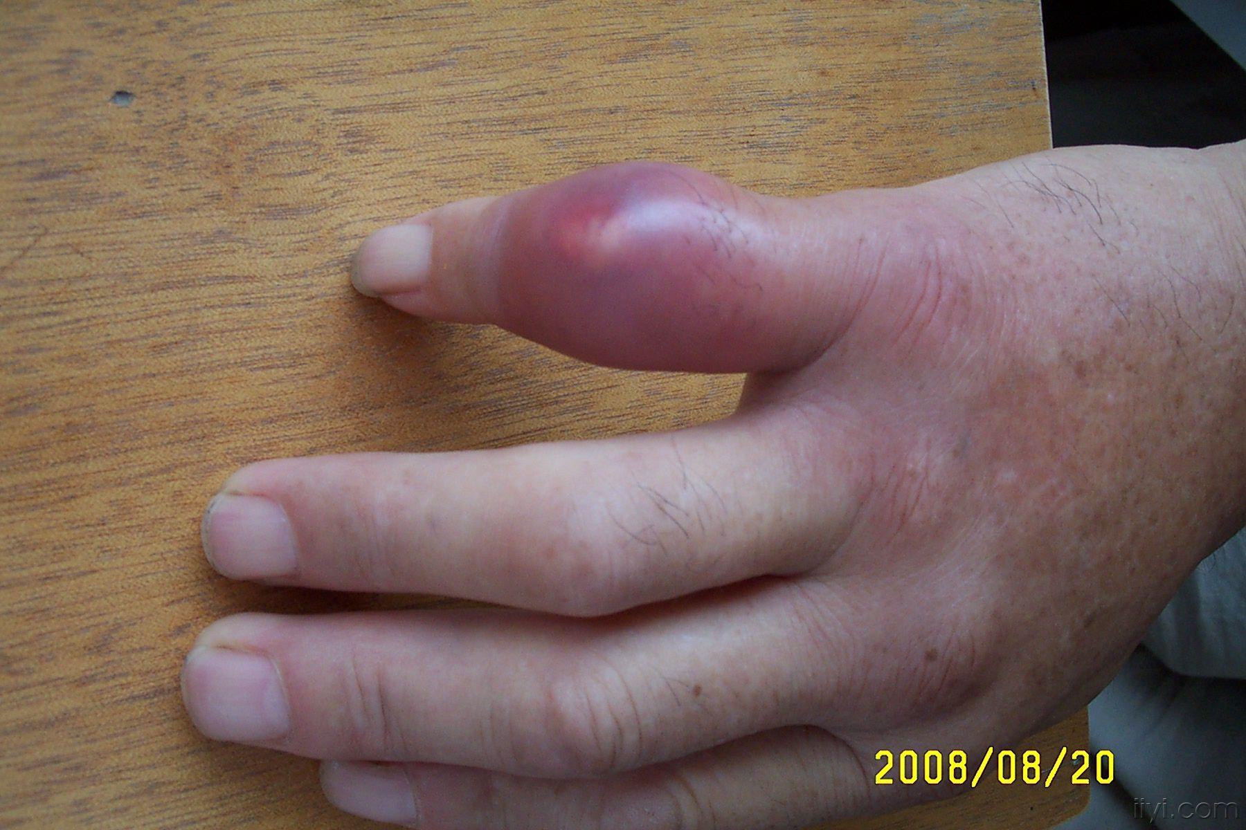 看图识病关节肿痛送鲜花哟