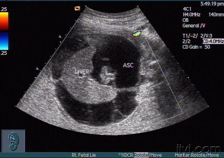 典型的胎儿腹腔积液