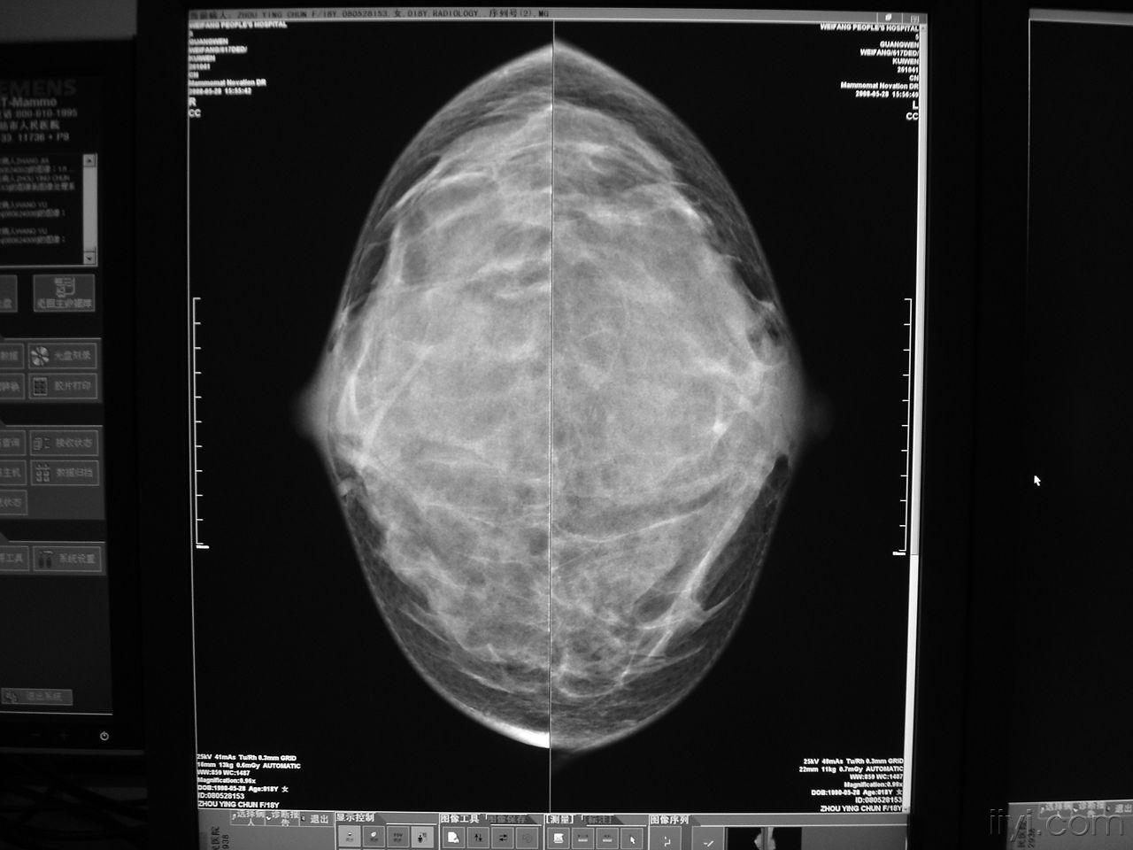 乳腺钼靶穿刺定位--为乳腺病人带来福音 - 影像医学和核医学讨论版 -丁香园论坛