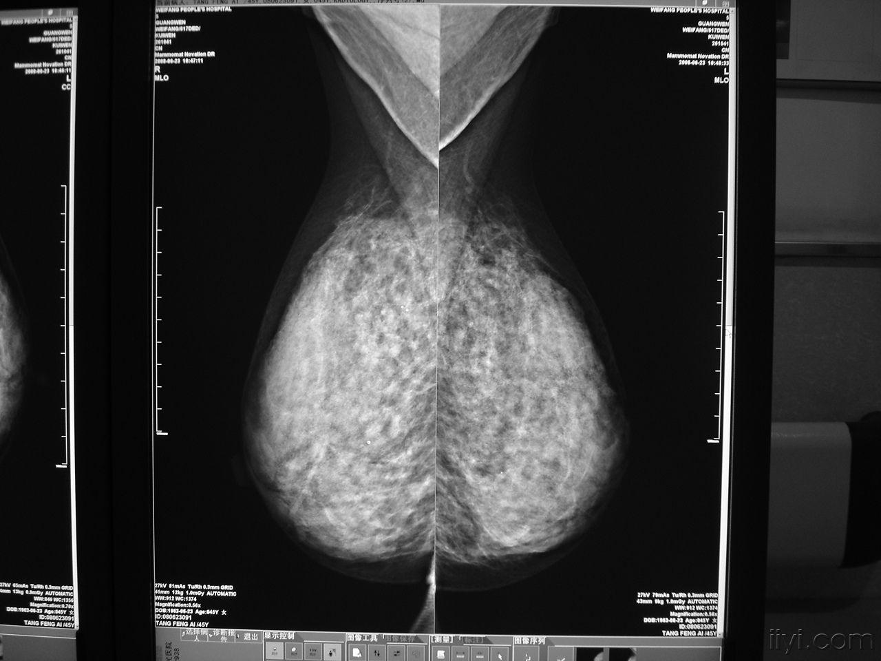 几种乳腺钼靶片的类型