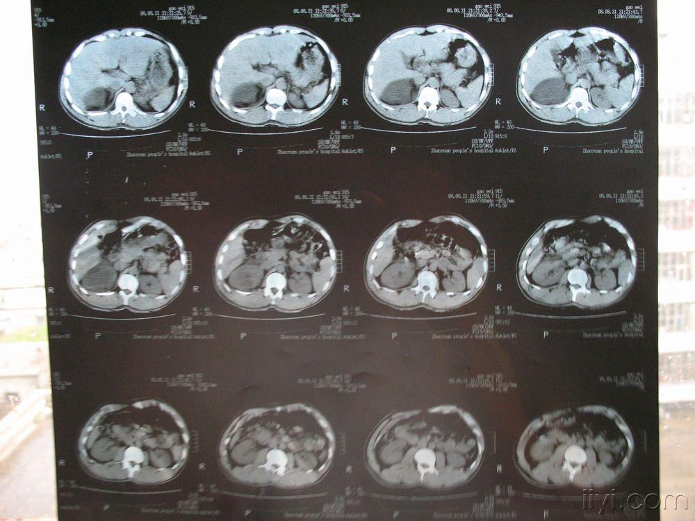 讨论外伤后右肝肾隐窝肿物