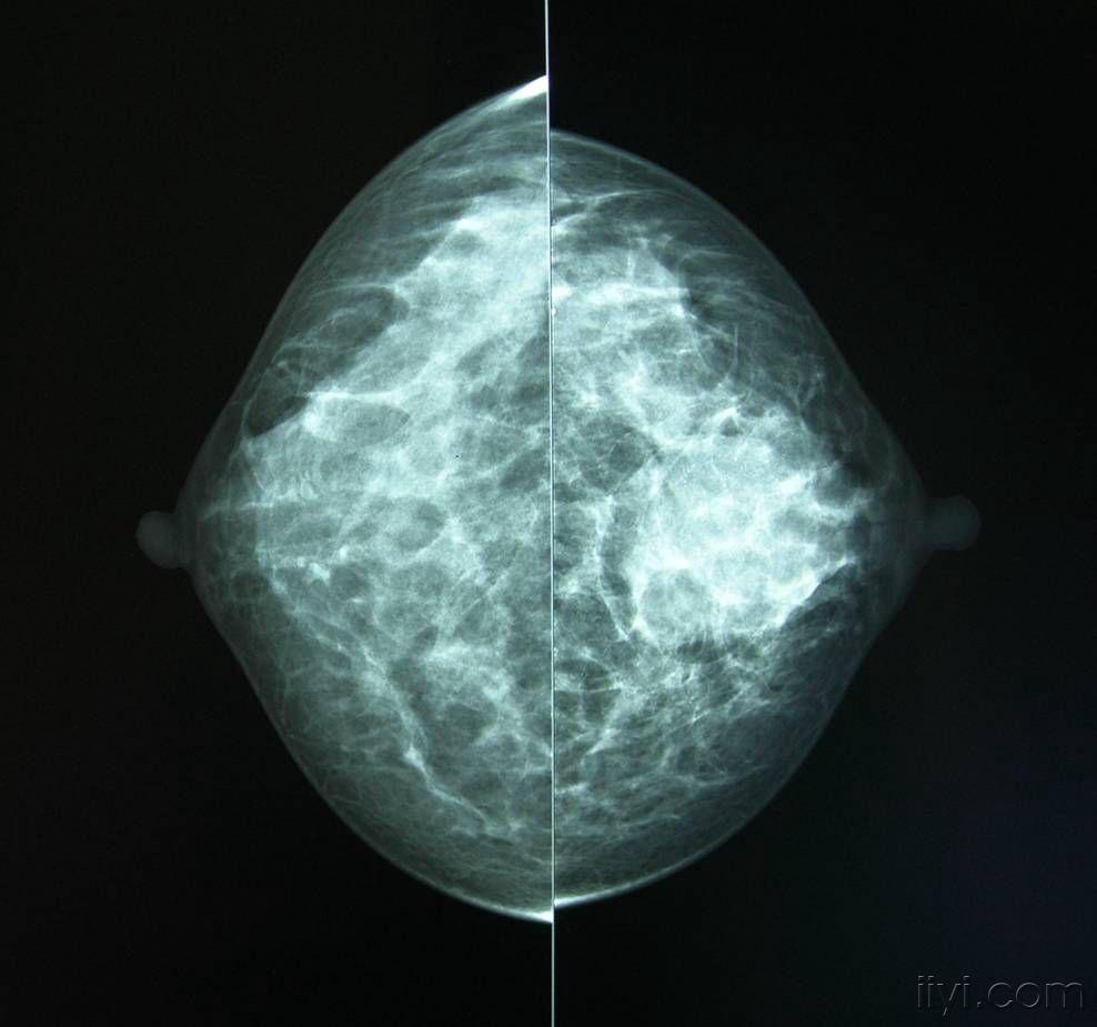 典型乳腺癌钼靶片附有病理