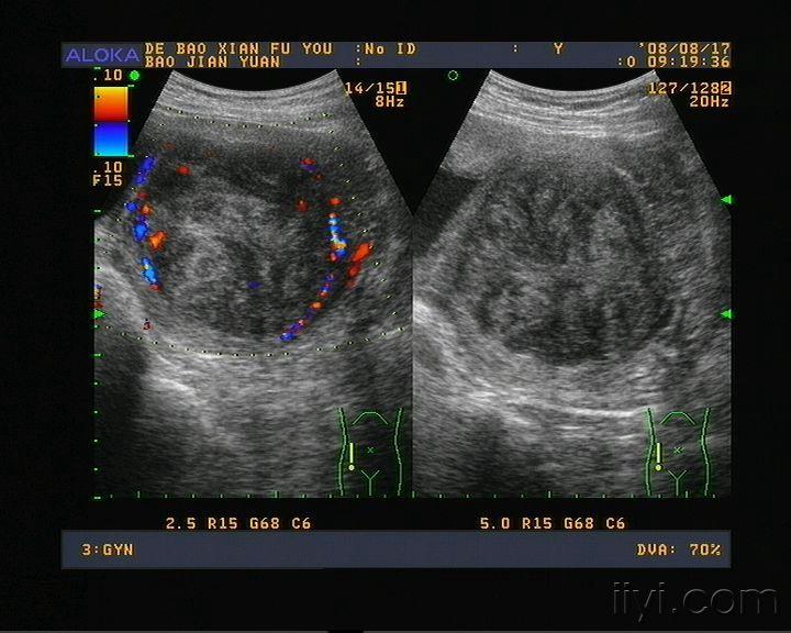 子宫肌瘤图片彩超图片