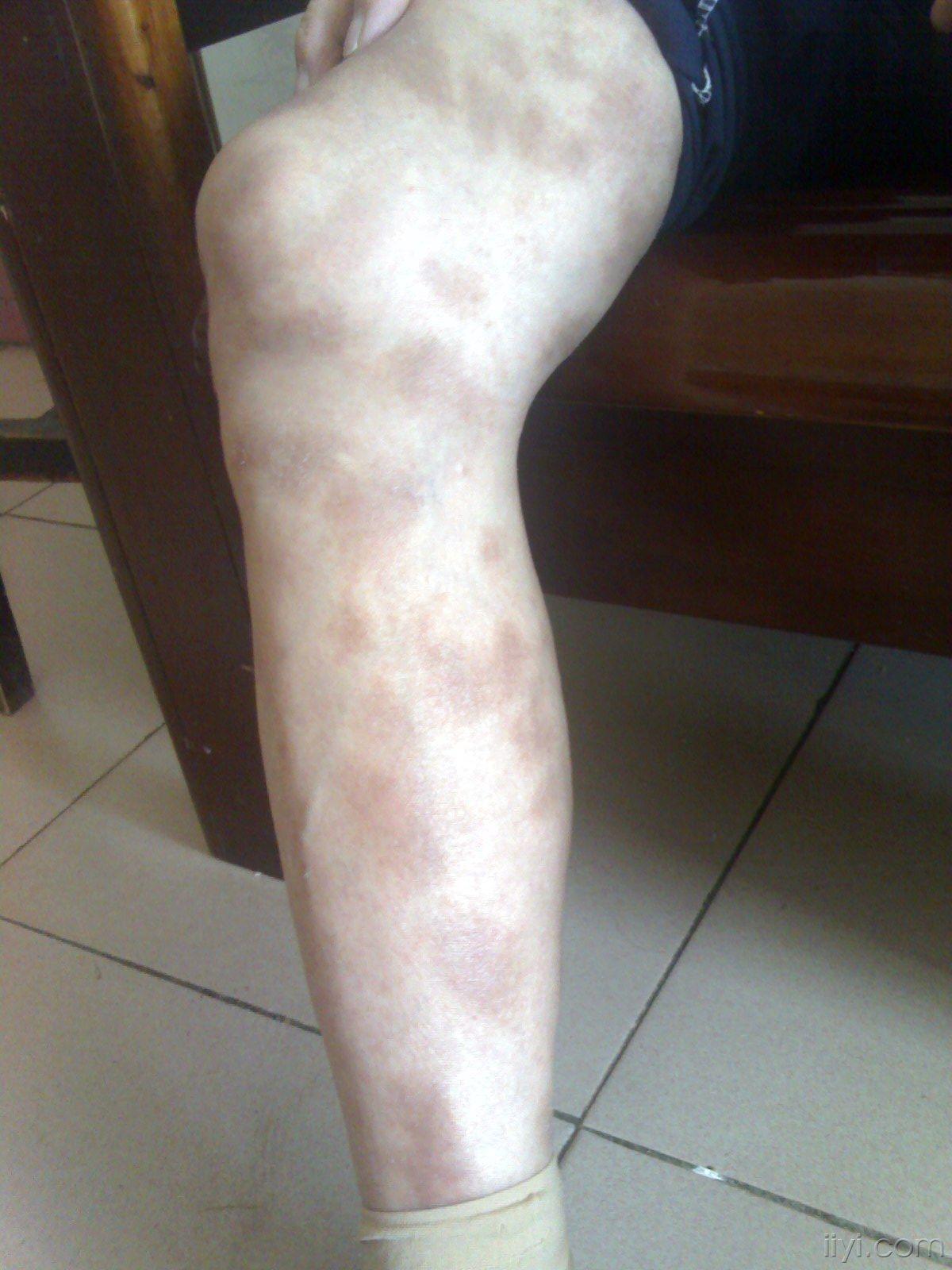 84岁女患者双下肢大量斑疹皮肤病达美康药物的不良反应