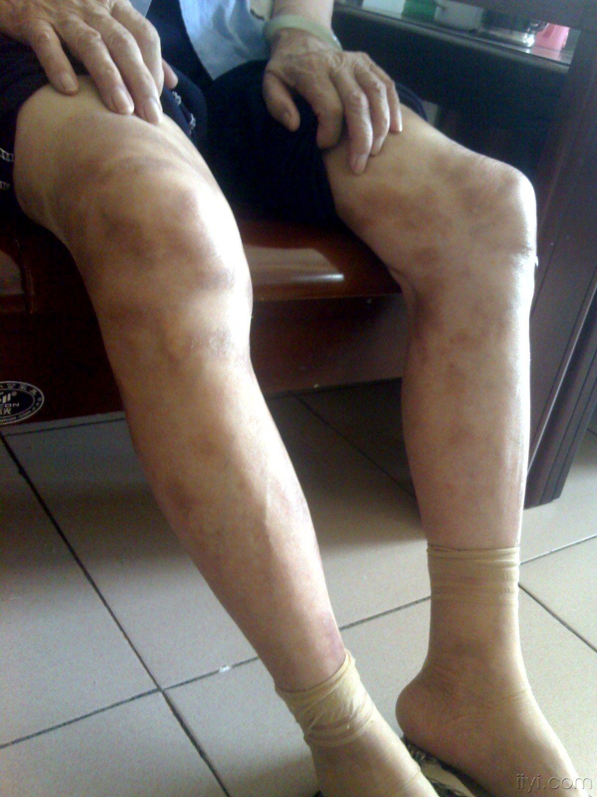 84岁女患者双下肢大量斑疹皮肤病达美康药物的不良反应