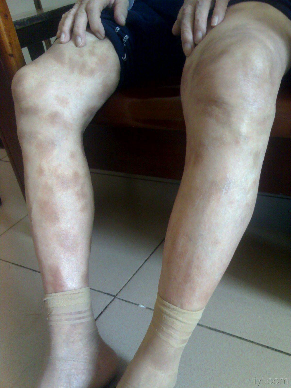 84岁女患者双下肢大量斑疹皮肤病达美康药物的不良反应
