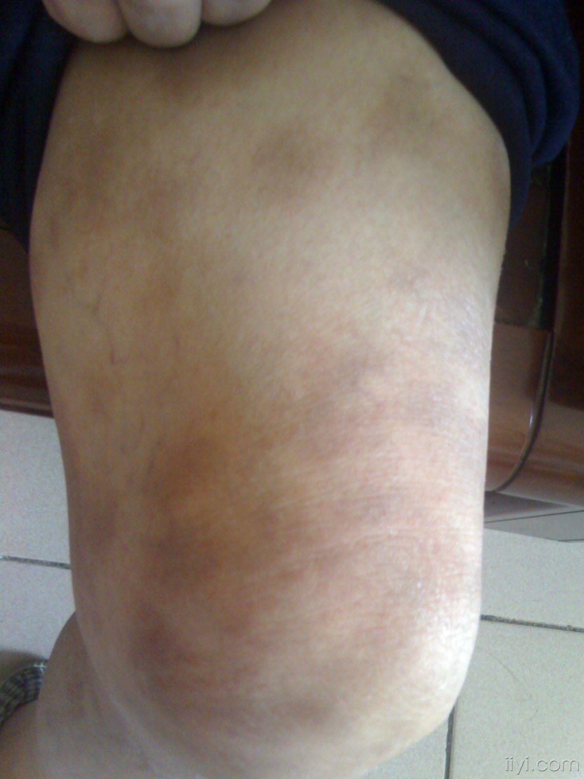 84岁女患者双下肢大量斑疹皮肤病达美康药物的不良反应