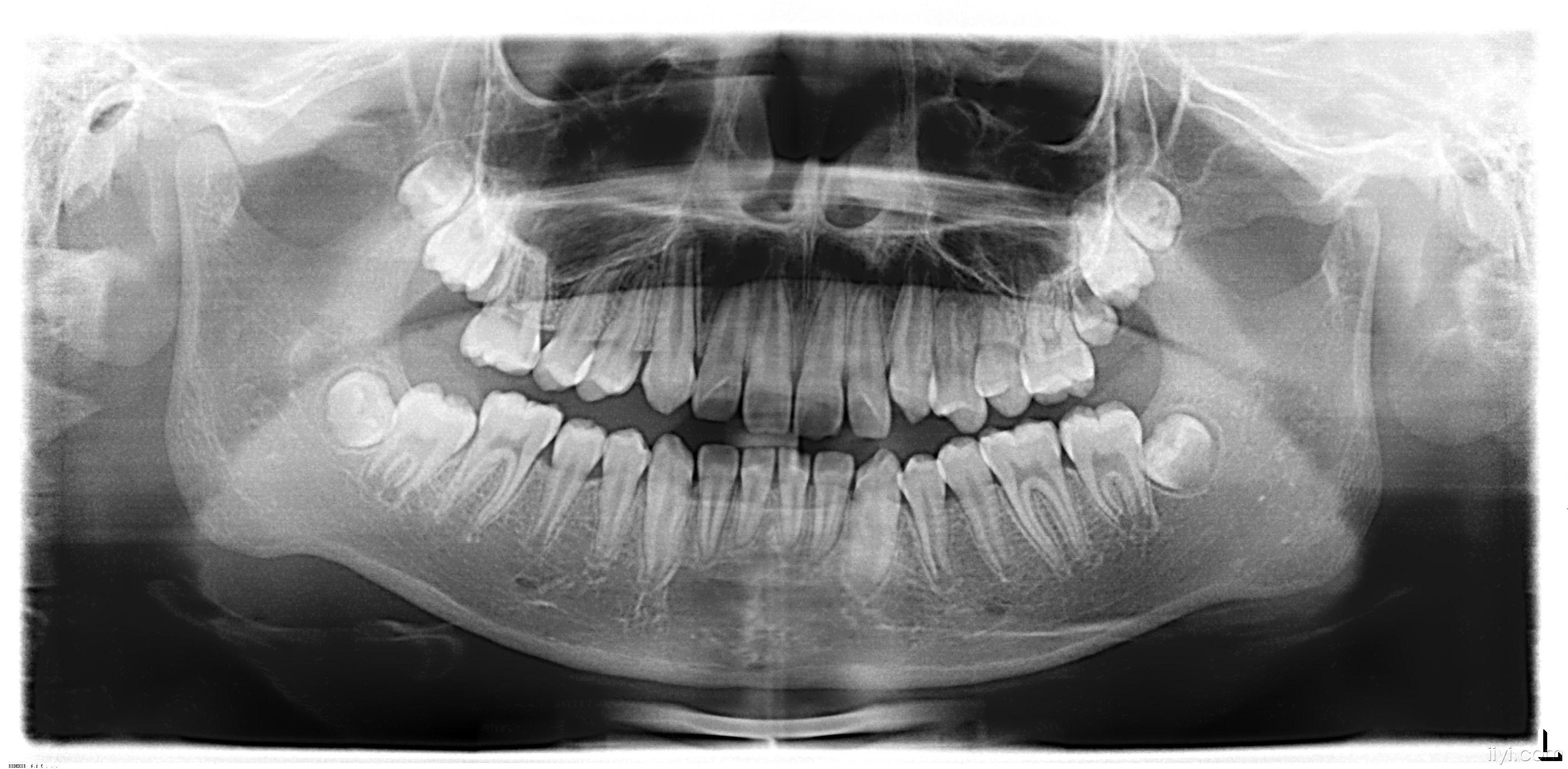 上颌6牙齿的颌面图片图片