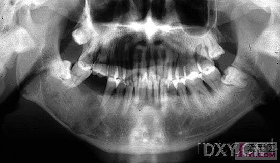 牙骨质骨化纤维瘤jpg