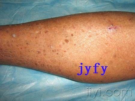 皮肤病灰泥角化病