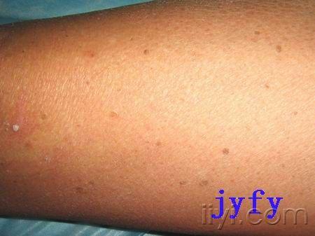 皮肤病灰泥角化病