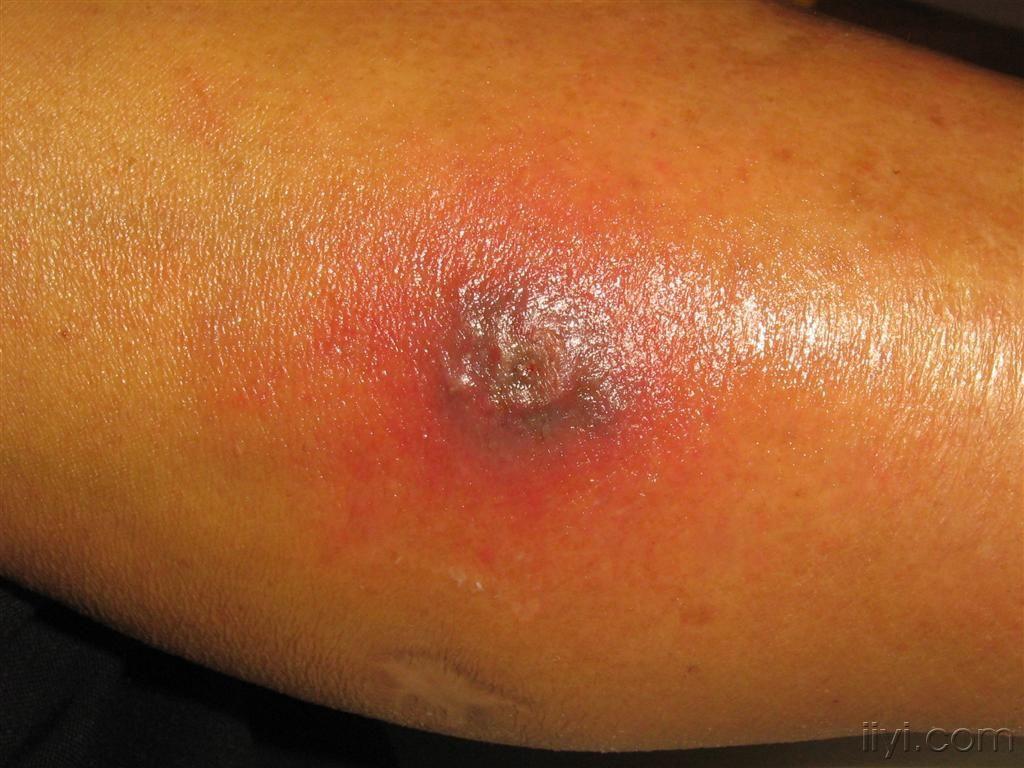 今日病例4已公布答案