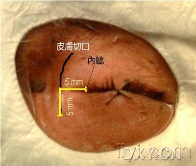 缝合睑裂,标识切口