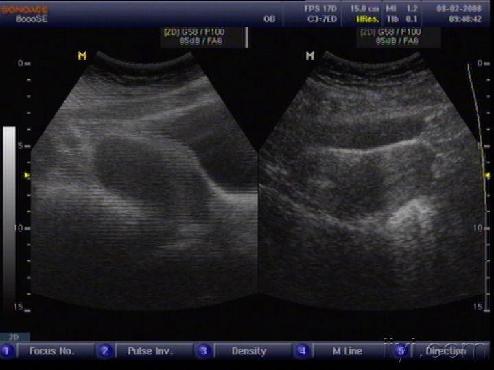 纵膈子宫 - 超声医学讨论版 - 爱爱医医学论坛