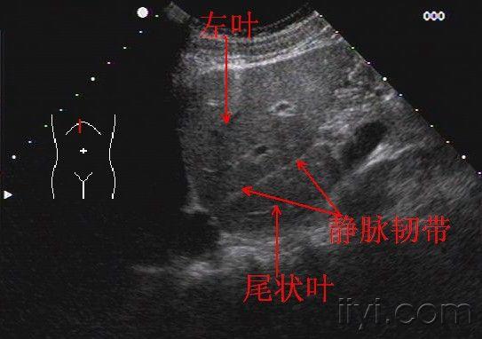 肝脏尾状叶超声图片图片