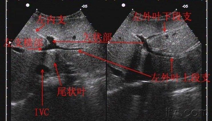 超声肝的分段解剖图片图片