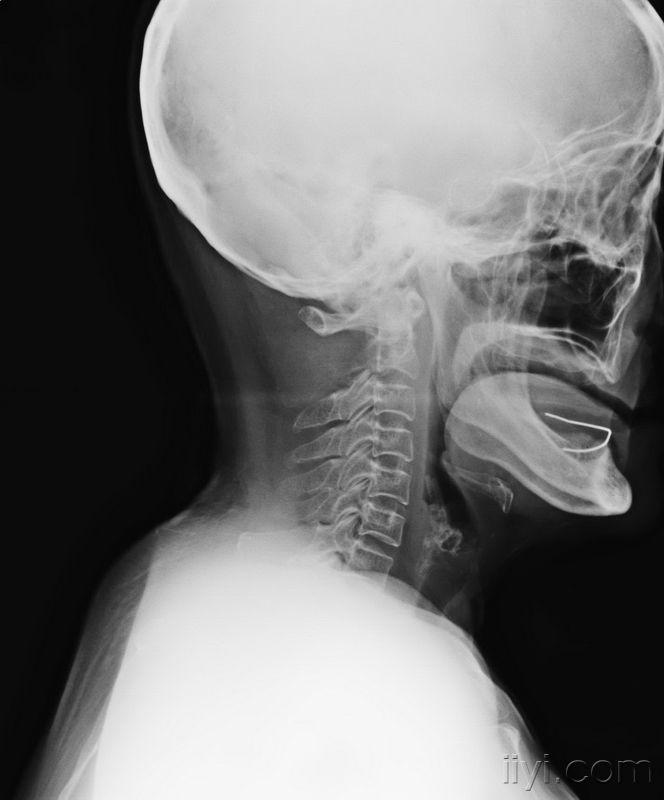 人体颈椎侧面图图片