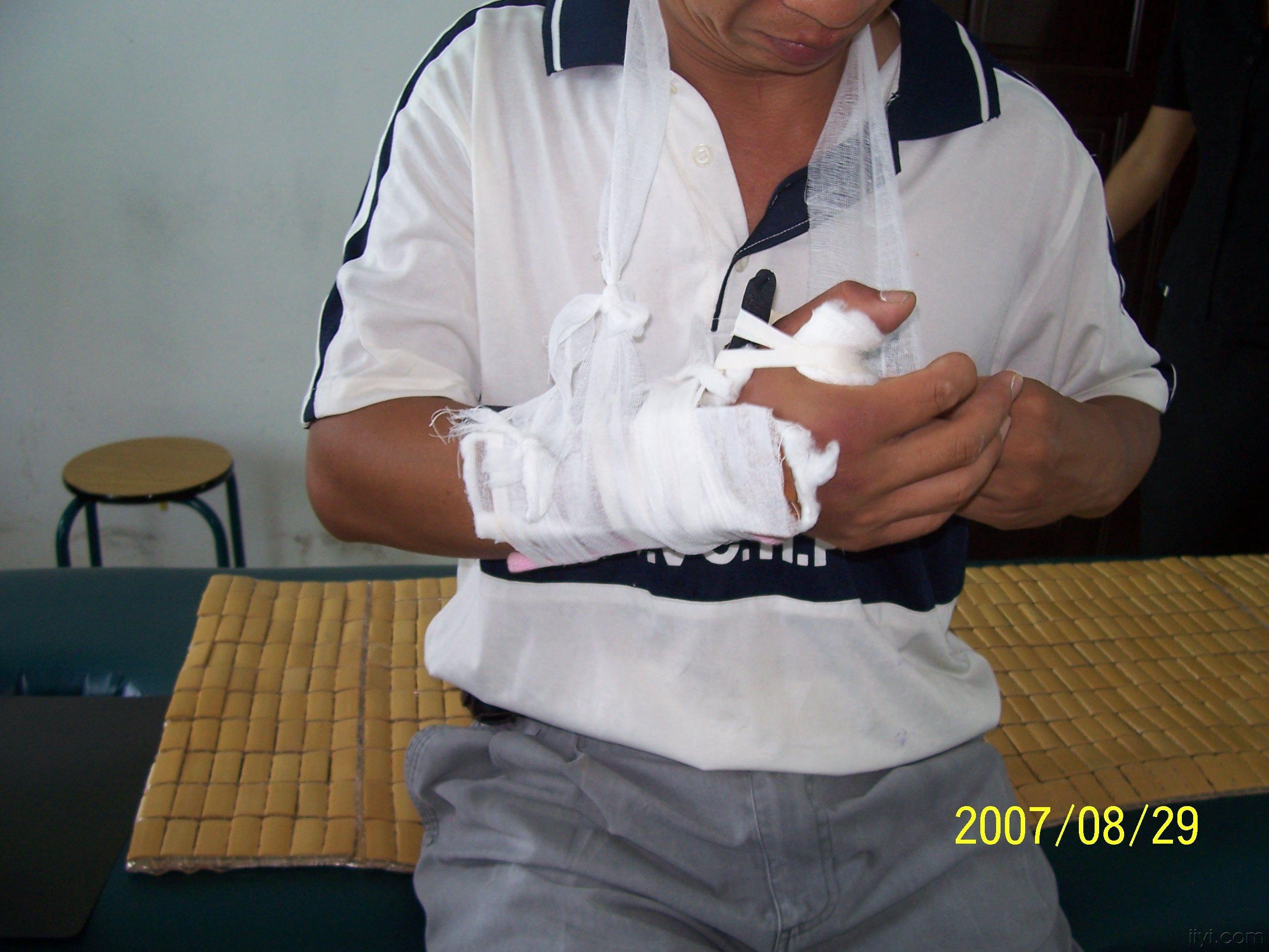 本奈氏骨折的小夹板外固定治疗讨论