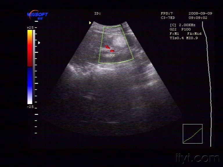 错构瘤超声图片