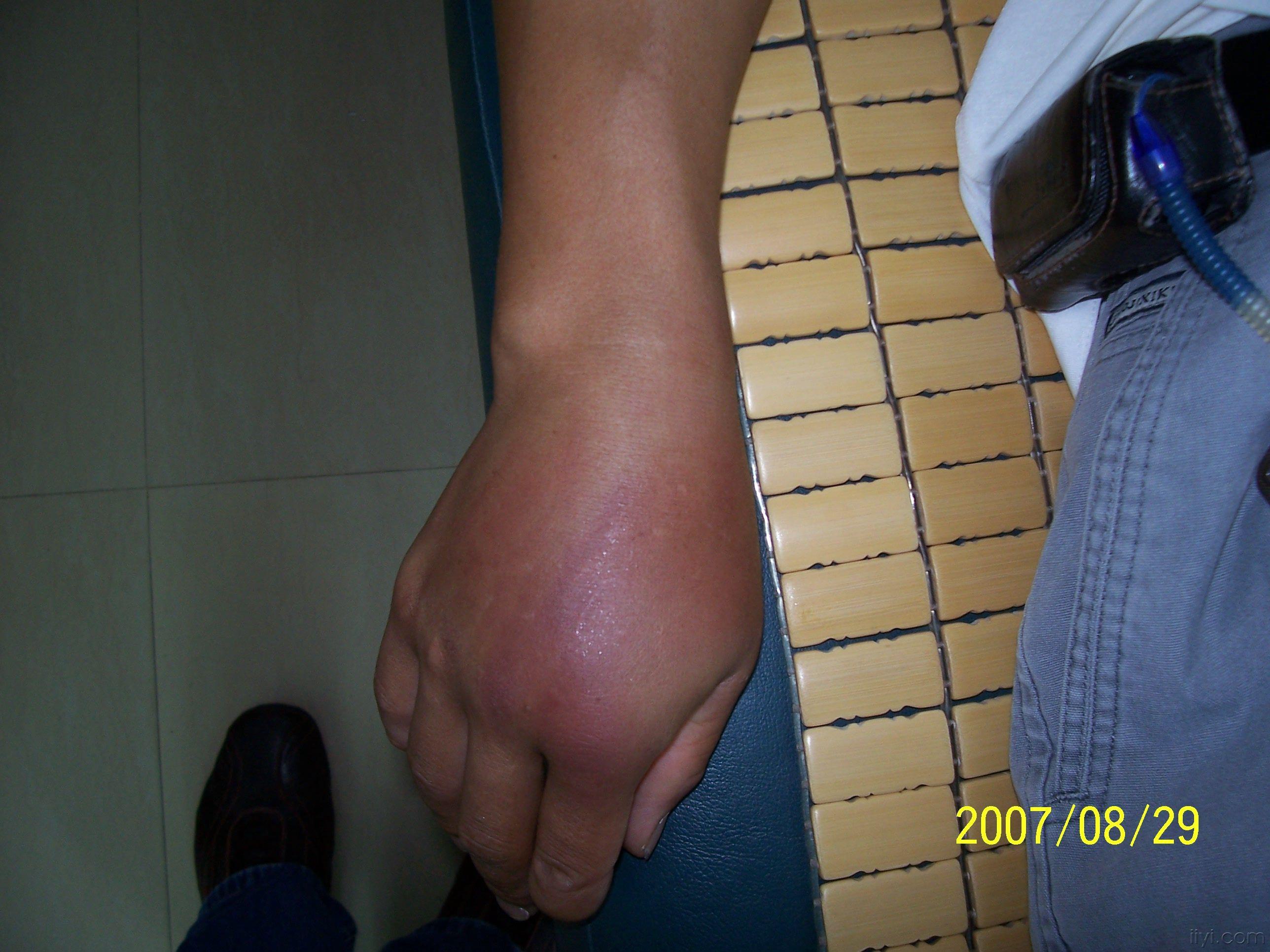 本奈氏骨折的小夹板外固定治疗讨论