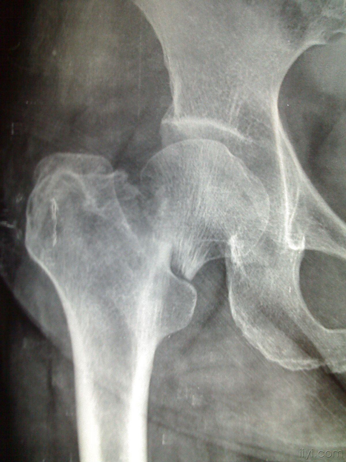 股骨颈骨折基底型图片