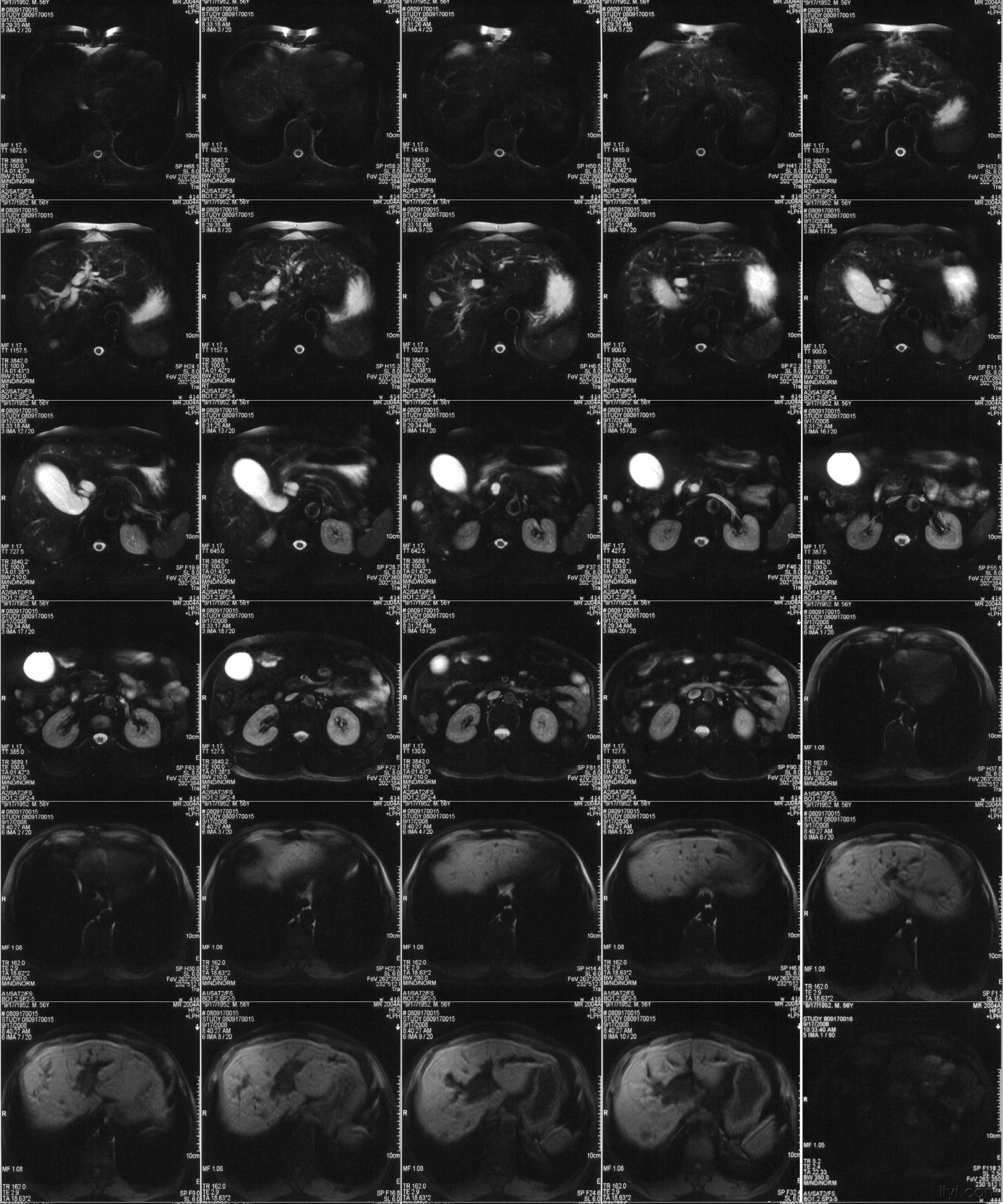 男56岁反复寒战高热一个多月彩超提示壶腹部胆总管末端占位
