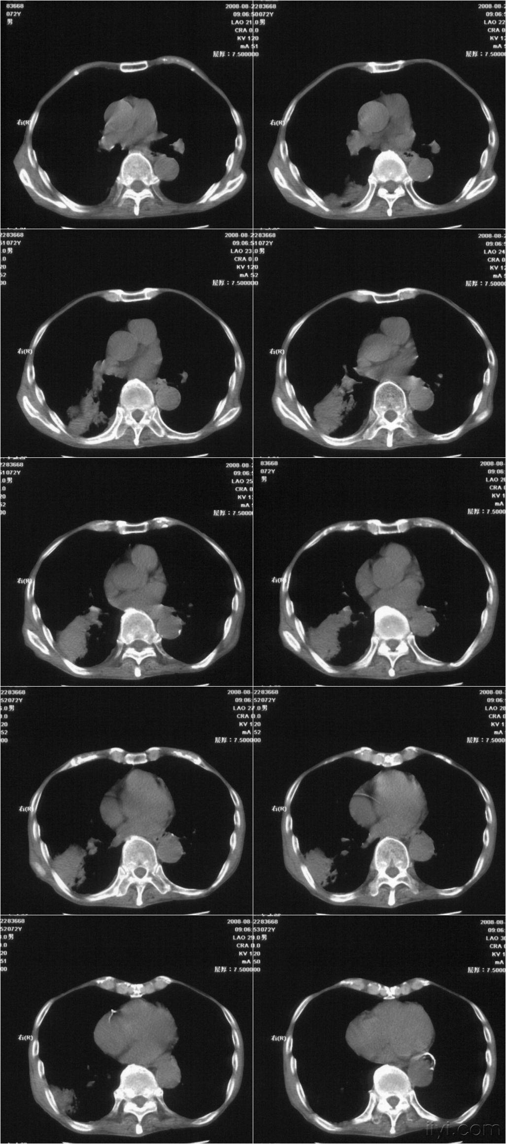 食管癌术后14年. - 医学影像学讨论版 - 爱爱医医学论坛