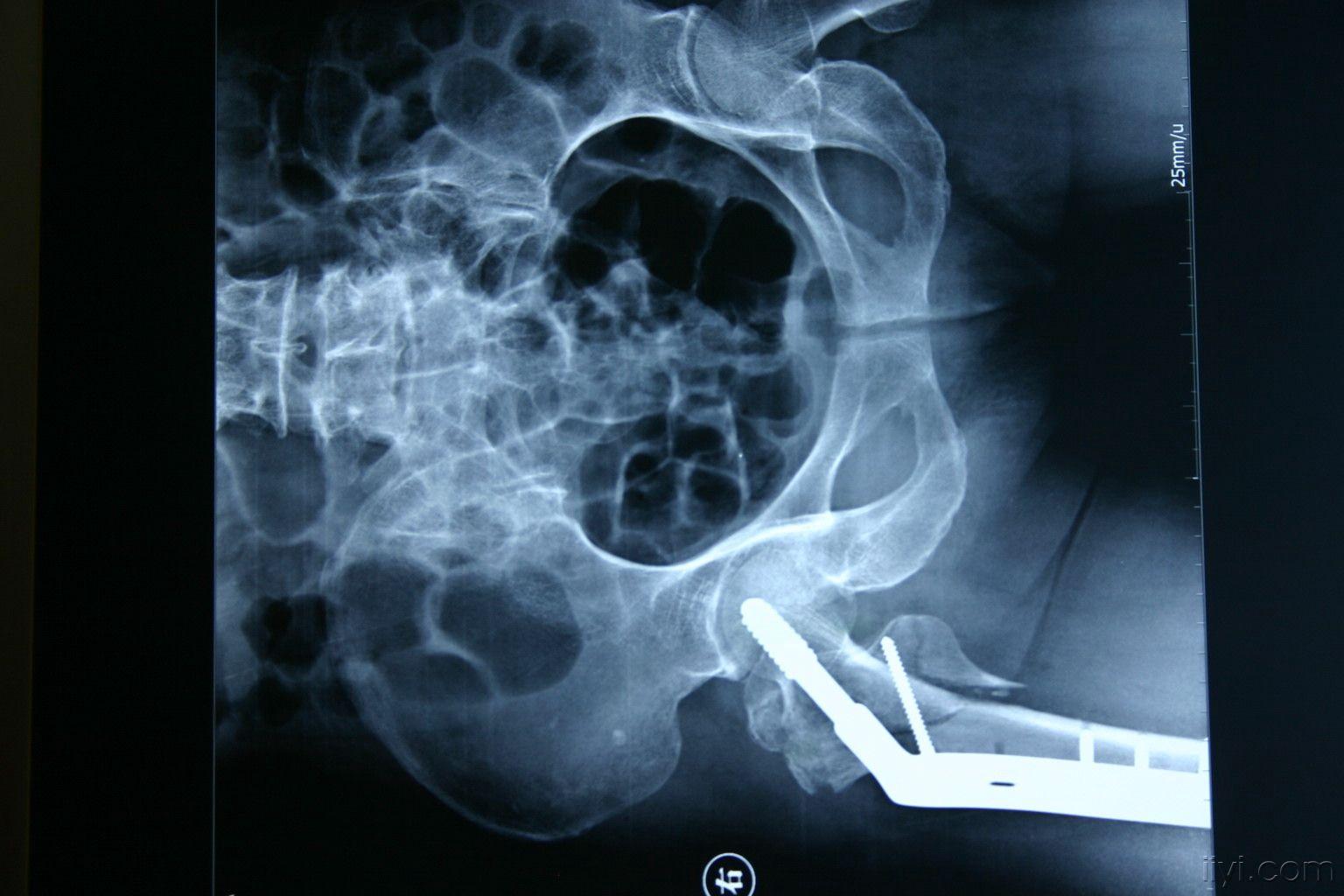 粗隆间骨折动力髋内固定