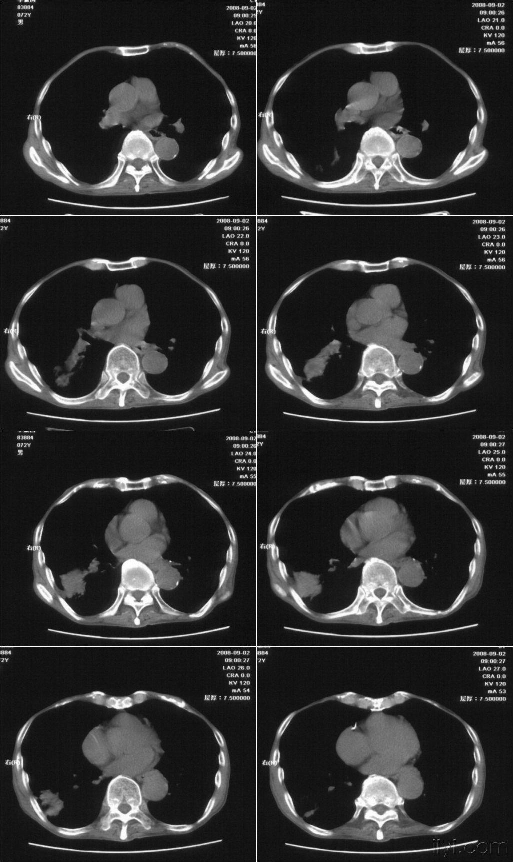 食管癌龛影图片图片